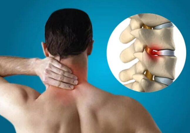Cervical osteocondrosis