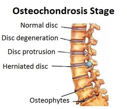 Stages of osteocondrosis