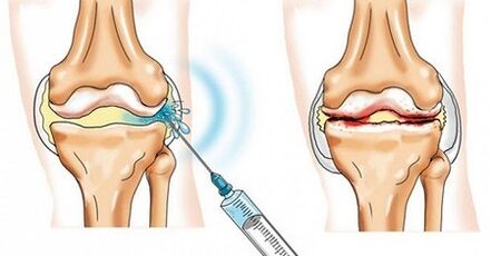 How to treat the arterry of the knee joint