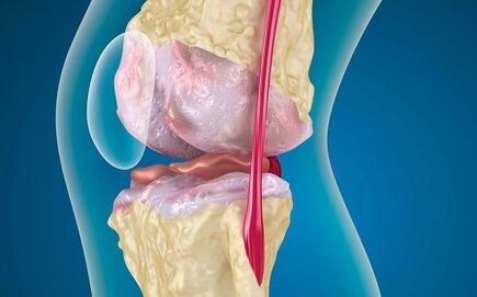 Reasons for the development of arthrosis of knee combination